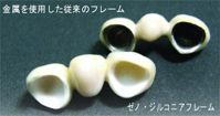 MBとジルコニア