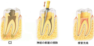 歯内療法